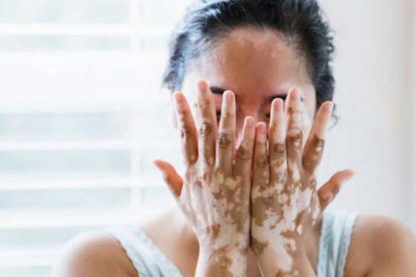 Dukung Pasien Percaya Diri, C Derma Tawarkan Solusi Medis untuk Vitiligo